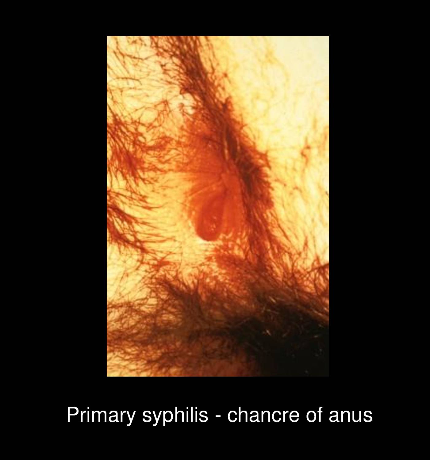 Syphilitic mucous patches on oral mucosa showing painless silver-gray erosions with surrounding erythema in secondary Treponema pallidum infection